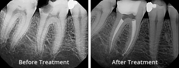 Root Canal before and after