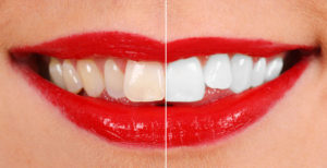 Teeth Whitening