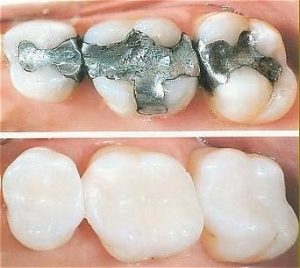 Tooth Coloured (Composite) Fillings